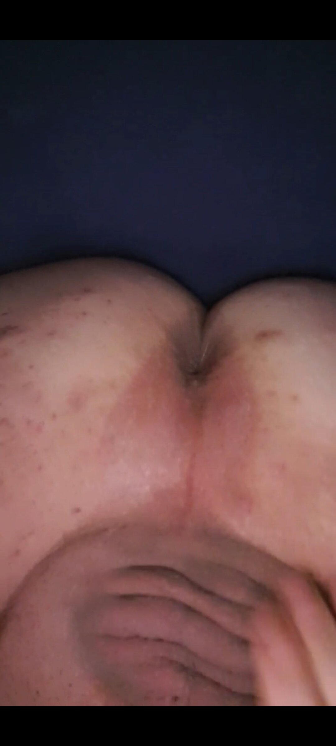 Normaldiick