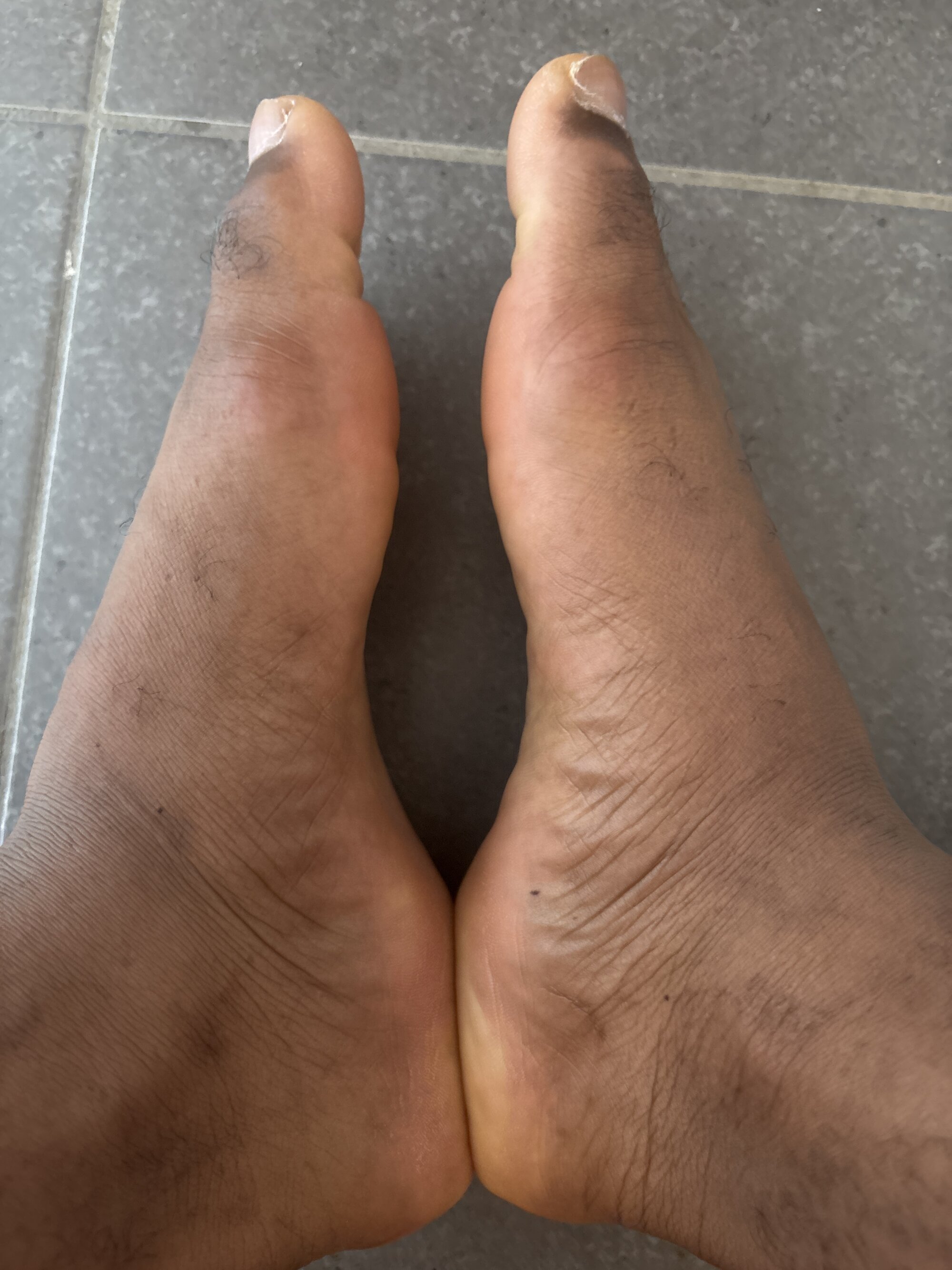 diakiterfusion